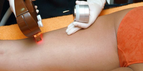 Depilacja laserowa